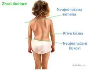 SKOLIOZA: kako da znaš da li je imaš?